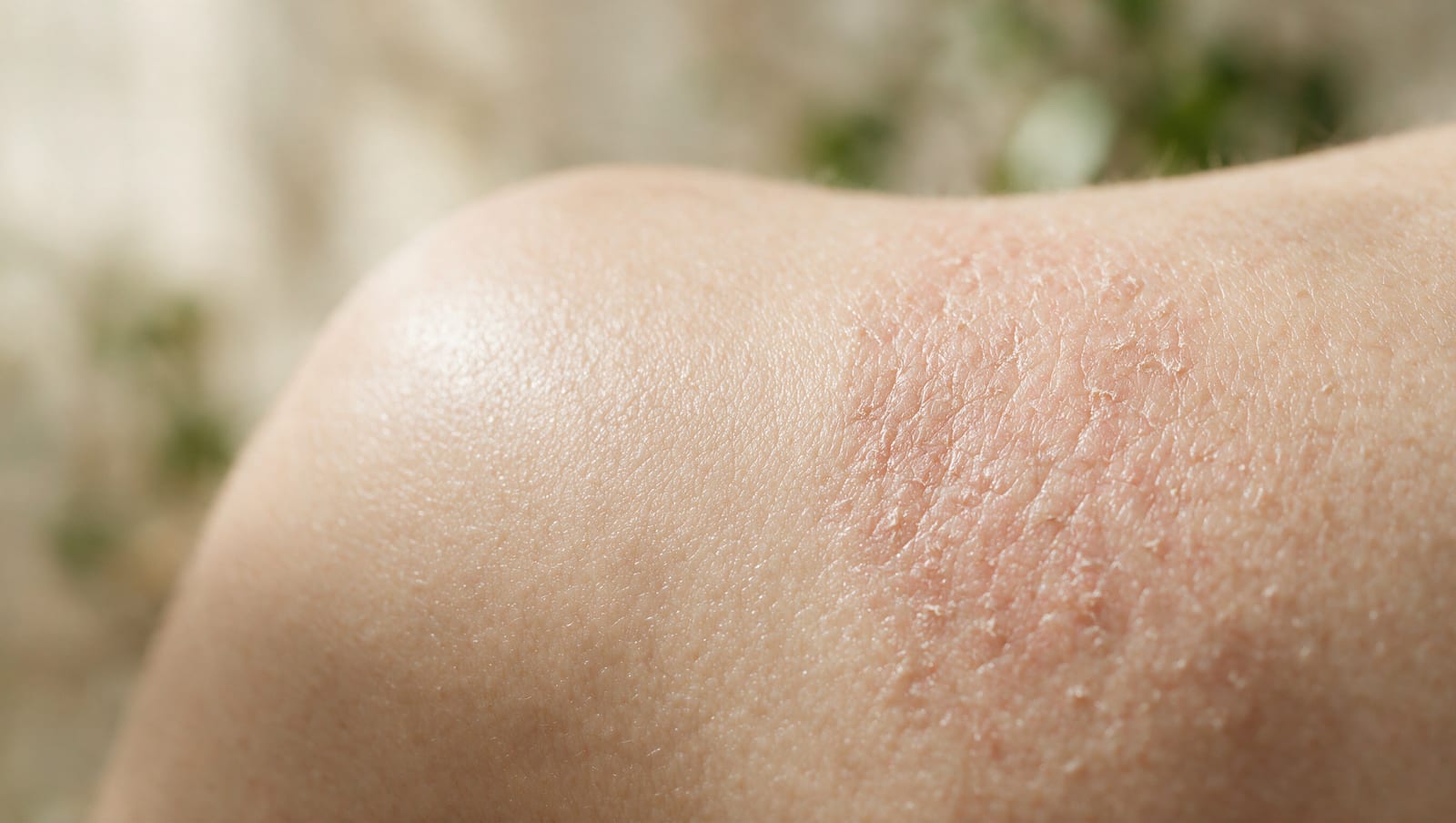 What Actually Causes Eczema?